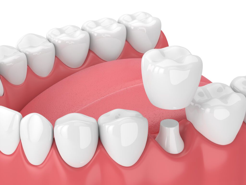 dental crowns in downers grove