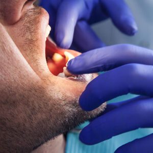 oral cancer screenings