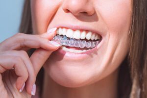 Invisalign family dentist Downers Grove Napierville