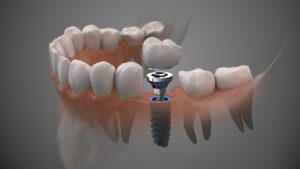 dental implants Downers Grove Naperville