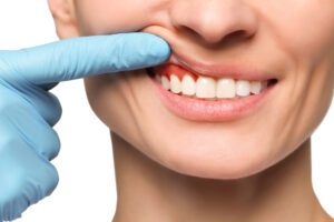 gum disease