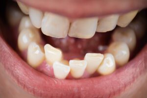 crowded teeth