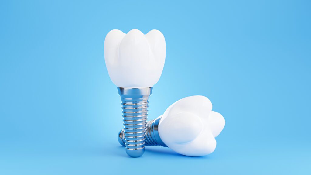 dental implants