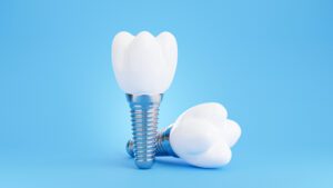 dental implants